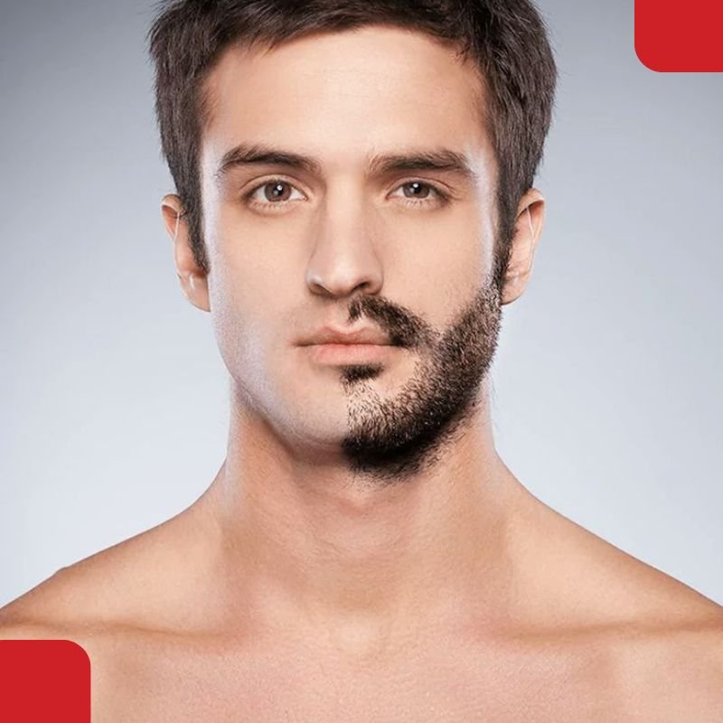 Beard Transplant in Coimbatore