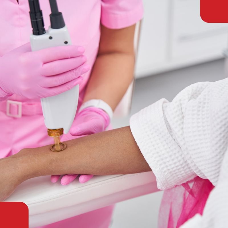 Diode Laser Hair Removal in Coimbatore