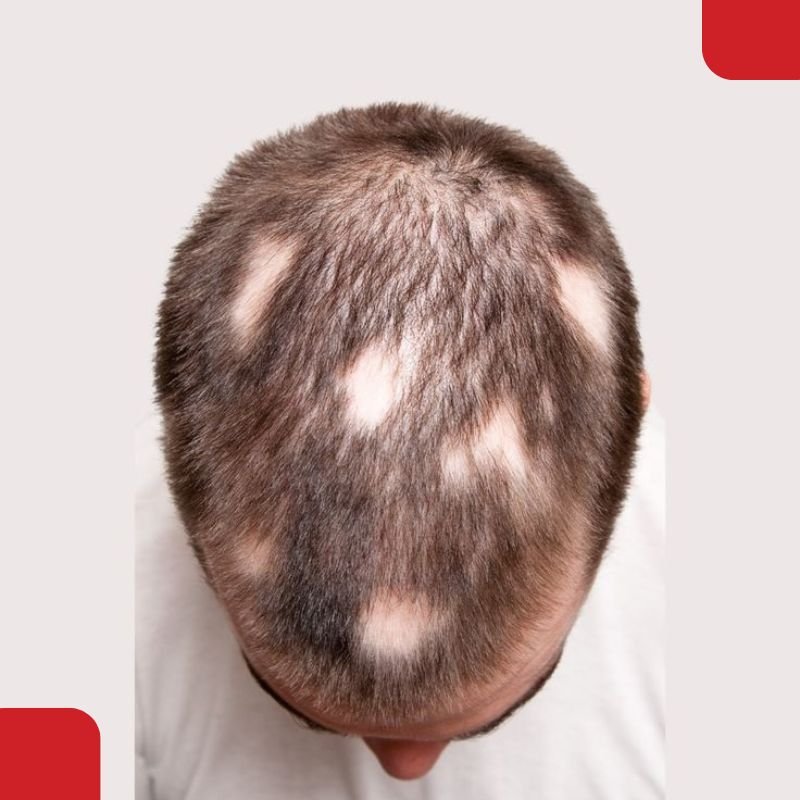 Partial Alopecia Treatment in Coimbatore