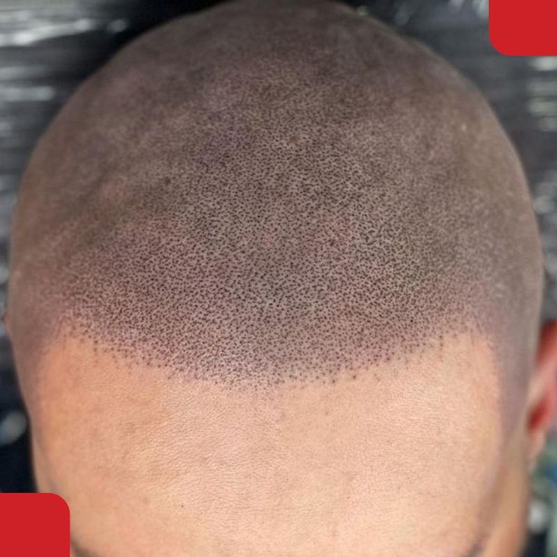Scalp Micropigmentation in Coimbatore
