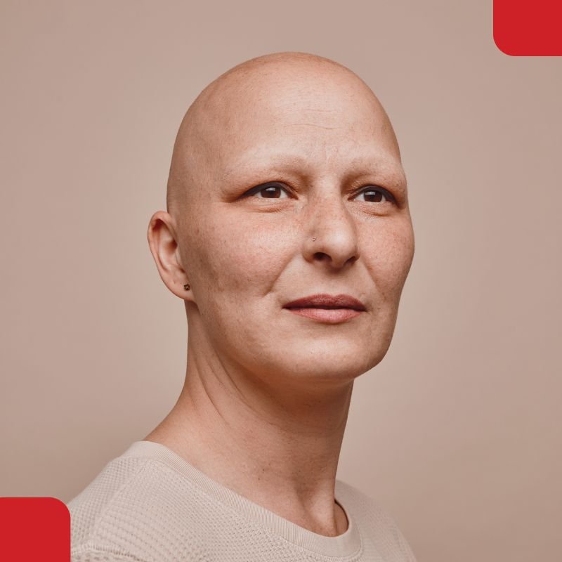 Total Alopecia Treatment in Coimbatore