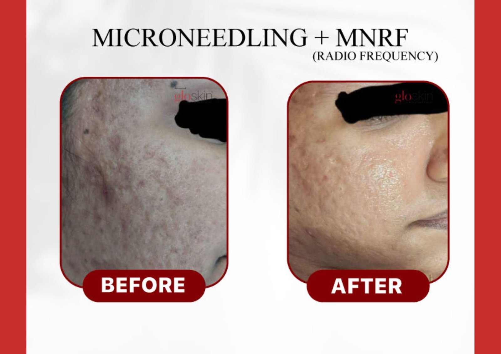 MIcroneedling-MNRF.jpg