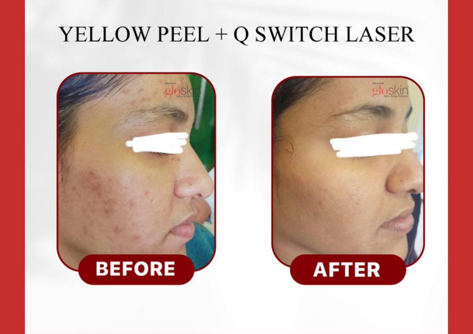 Yellow-Peel-Q-switch-1.jpg