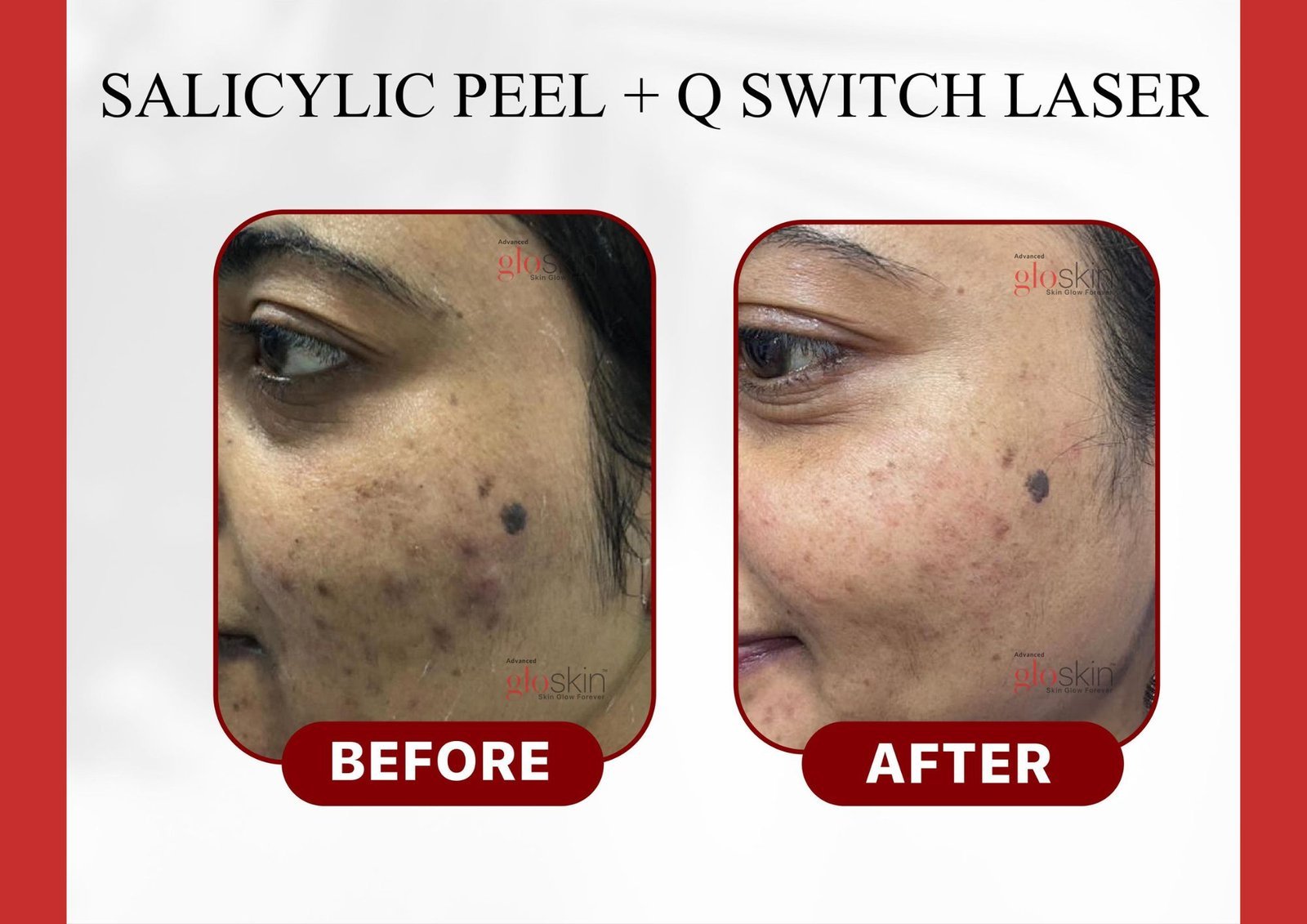 salicylic-peel-Q-switch-1.jpg