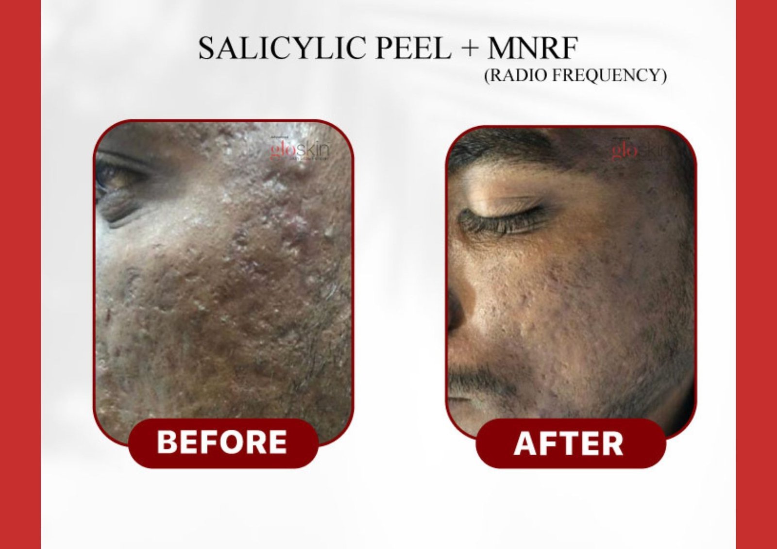 salicylic-peel-mnrf.jpg