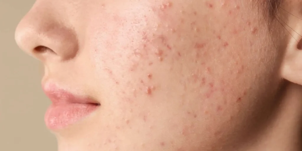 Acne Treatment in Coimbatore (1)