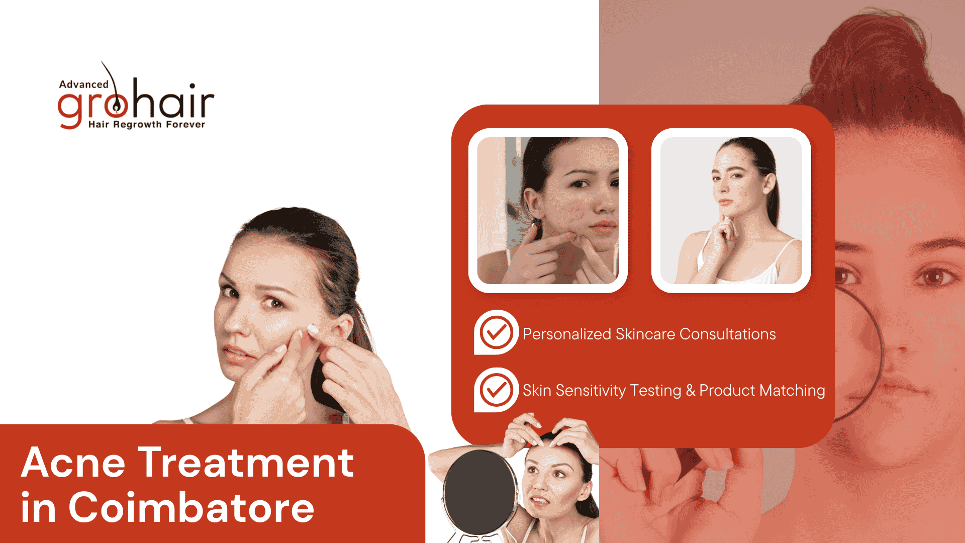 Acne Treatment in Coimbatore