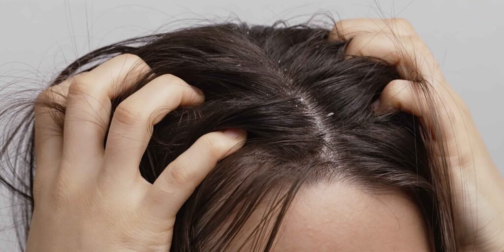 Dandruff Treatment in Coimbatore