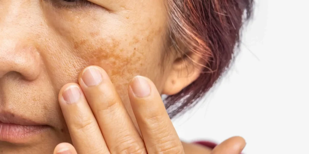 Skin Pigmentation Treatment in Coimbatore