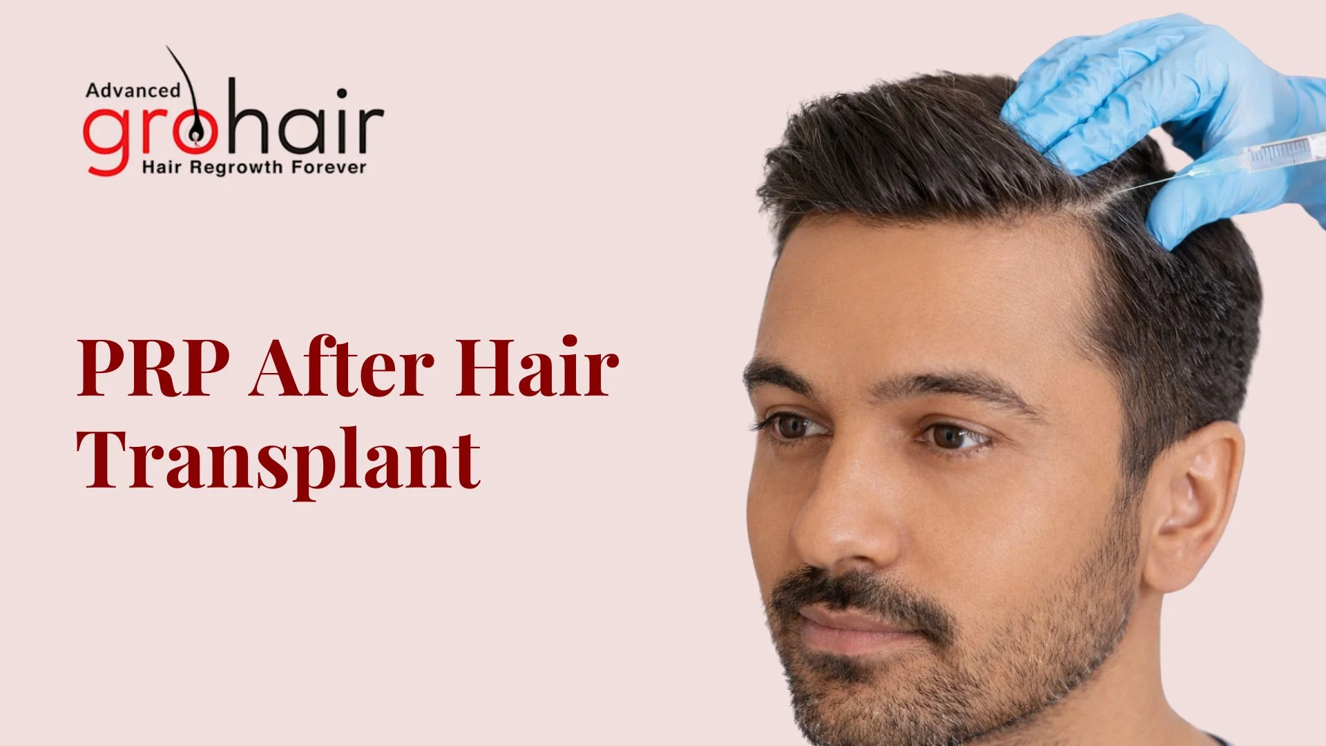 PRP After Hair Transplant